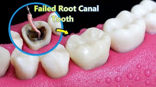 INCREDIBLE Reconstruction Of PoorFailed Root Canal Treated Tooth [upl. by Nylear]