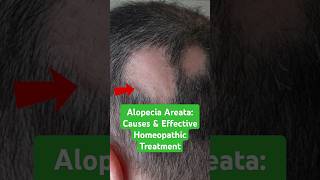 Alopecia Areata Causes amp Effective Homeopathic Treatment shorts [upl. by Hayward]