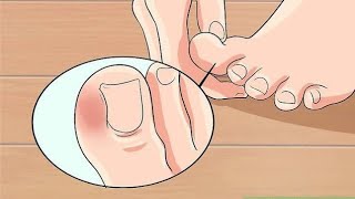 How to Cure an Infected Toe [upl. by Bunny342]