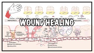 Wound Healing  Stages of healing and pathology [upl. by Martina]