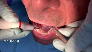 Teeth Cleaning  Removal Of Tartar [upl. by Augusta]