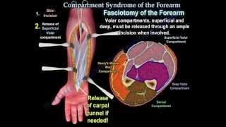 Compartment Syndrome Of The Forearm  Everything You Need To Know  Dr Nabil Ebraheim [upl. by Semaj92]