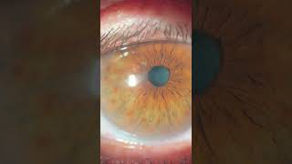 Acute angleclosure glaucoma [upl. by Nivrehs]