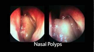 AAOHNSF The ENT Exam Episode 4 The Nasopharynx and Larynx Exam [upl. by Bush228]