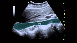 Ultrasound of the IVC [upl. by Lantha]