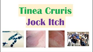 Jock Itch Tinea Cruris  Causes Risk Factors Signs amp Symptoms Diagnosis and Treatment [upl. by Yelmene25]