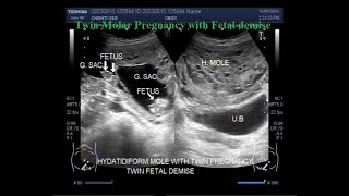 Twin molar pregnancy with Fetal demise [upl. by Millard]