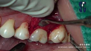 Technique to debridement with furcation [upl. by Eitac166]