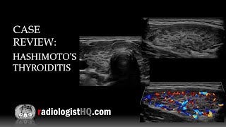 Ultrasound of Hashimoto’s Thyroiditis [upl. by Benedetta896]