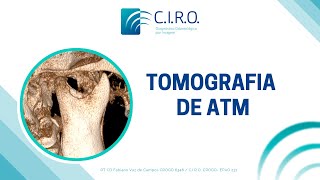 Tomografia da articulação temporomandibular ATM [upl. by Dara26]