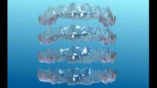 Information sur Invisalign [upl. by Melodee]