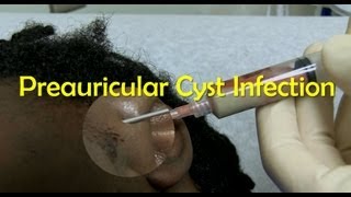 Preauricular Cyst Infection Management [upl. by Eleaffar]