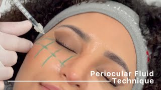 Periocular Fluid Technique injection protocol by Dr Siquier amp Dr Taskesen [upl. by Elocn]