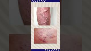 Varicose Veins Surgery Explained Procedure Benefits amp Recovery [upl. by Attelocin]