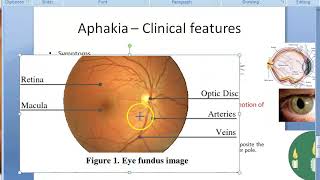 Ophthalmology 047 b Aphakia Clinical features [upl. by Nialb306]