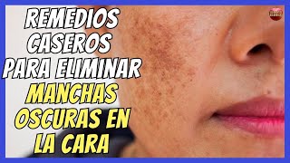 🩷 REMEDIOS CASEROS PARA ELIMINAR MANCHAS OSCURAS EN LA CARA 🩷 [upl. by Nali]