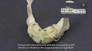 Straumann® Guided Surgery System and Straumann® BLT [upl. by Johst]