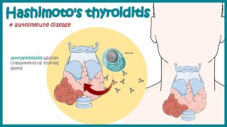 Hashimotos thyroiditis  Autoimmune diseases [upl. by Nnayllehs498]