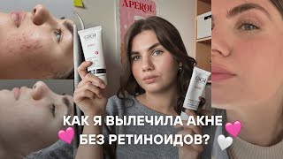 КАК Я ВЫЛЕЧИЛА АКНЕ БЕЗ РЕТИНОИДОВ  сияющая кожа  уход для проблемной кожи [upl. by Nessa667]