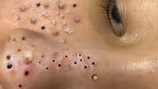 Big Cystic Acne Blackheads Extraction Blackheads amp Milia Whiteheads Removal Pimple Popping  212 [upl. by Earezed]