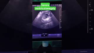 ventriculomegaly ultrasound usg pregnancy anomaly [upl. by Artened65]