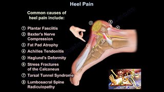 Heel Pain causes and treatment plantar fasciitis diagnosis and treatment [upl. by Attenauq855]