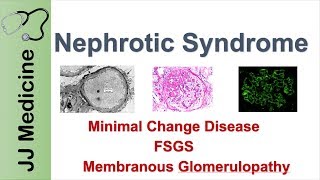 Nephrotic Syndrome  Clinical Presentation Causes and Treatment [upl. by Lamee15]