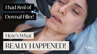 Full Face Dermal Filler 😱 Heres what REALLY happened 2021 [upl. by Enelrahs574]