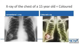 Radiologic Manifestations of Thoracic Hydatid Cyst pulmonary and extrapulmonary findings [upl. by Branscum]