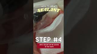 Sealant Procedure Applying the Sealant  In Office to Hands On Dental Training [upl. by Enirbas]