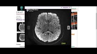 Cytotoxic lesions of the corpus callosum [upl. by Aimehs]