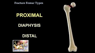 Fracture Femur Types  Everything You Need To Know  Dr Nabil Ebraheim [upl. by Ainollopa]