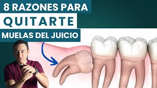 8 razones para quitarte las muelas del juicio [upl. by Peursem]