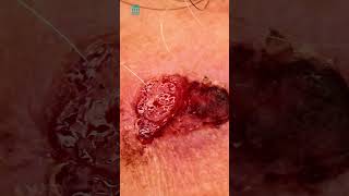 What is squamous cell carcinoma  Shorts [upl. by Anegroeg]