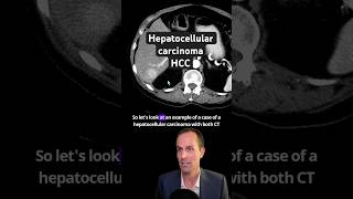 Abdominal CT Tutorials  Hepatocellular carcinoma HCC [upl. by Nahgam]