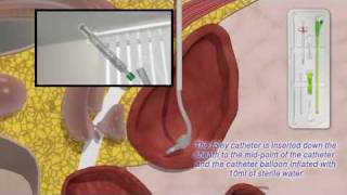 Mediplus Ltd  SCath TM System Inserting a Foley catheter suprapubically [upl. by Ynneb]