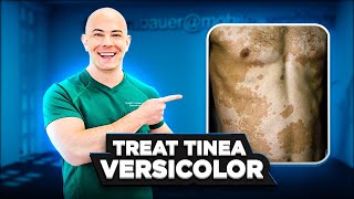 How to Treat Tinea Versicolor and Keep it From Coming Back  🛑 SEE MY PINNNED COMMENT FOR UPDATE👇 [upl. by Chapnick]