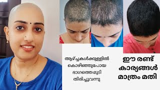 ഇതുപോലെ മൊട്ടയടിച്ച് കൊഴിഞ്ഞുപോയ മുടി വളർത്താൻ ആർക്കെങ്കിലും സാധിക്കുമോ My Hair Regrowth Secrets [upl. by Seavey]