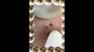 Pimple Popping Ingrown Hair Removal amp Blackhead Extractions  Ultimate Skincare very satisfying [upl. by Gross]