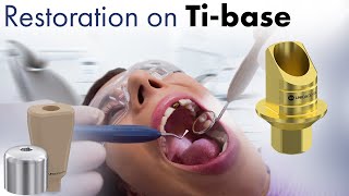 Do you need to use a Ti base The different types of dental parts amp digital impression [upl. by Anohs]