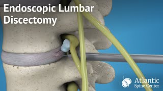 Endoscopic Lumbar Discectomy [upl. by Candace]