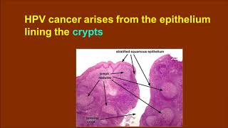 HPV and Oropharynx Part 1 [upl. by Lingwood977]