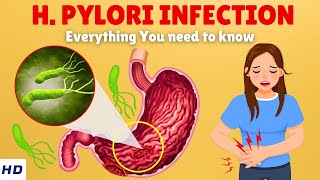 Helicobacter Pylori Infection – Causes Signs and Symptoms Diagnosis amp Treatment [upl. by Eikciv]