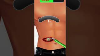 عملية جراحية لإزالة كتلة دهنية من البطن Surgery to remove a fatty mass from the abdomen طبيب [upl. by Fablan]