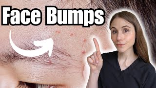 Face Bumps THAT ARE NOT Fungal Acne [upl. by Mcgill]