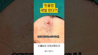 표피낭종 피지낭종 핀홀법 수술 재발하는가 피부 낭종 성형외과 병원 epidermal epidermoid cyst pinhole technique surgery seoul [upl. by Naor411]