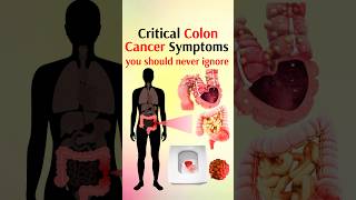 Critical colon cancer symptoms shorts [upl. by Brosy116]