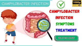 Campylobacter Infection Its Symptoms amp Possible Treatments  What Is Campylobacter Infection📢📢📢📢 [upl. by Htinek]