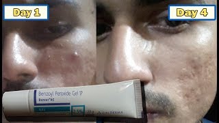 Acne transformation with Benzoyl peroxide 25 [upl. by Orgel]