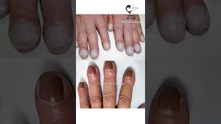 உங்கள் நகங்கள் இவ்வாறு இருக்கிறதா Changes in nails and diseases Dr Isacc Abbas [upl. by Eelyrag]